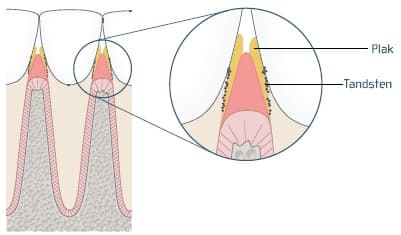 Plak og tandsten på tand